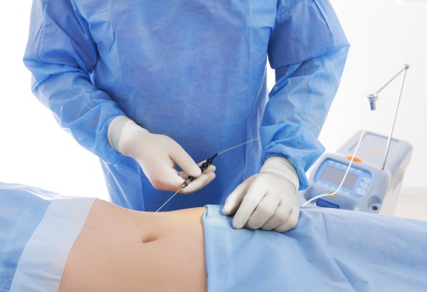 Lipoliza laserowa - alternatywa chirurgicznego odsysania tłuszczu